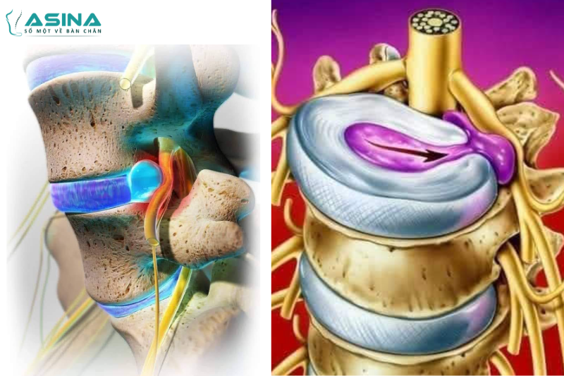 Thoát vị đĩa đệm