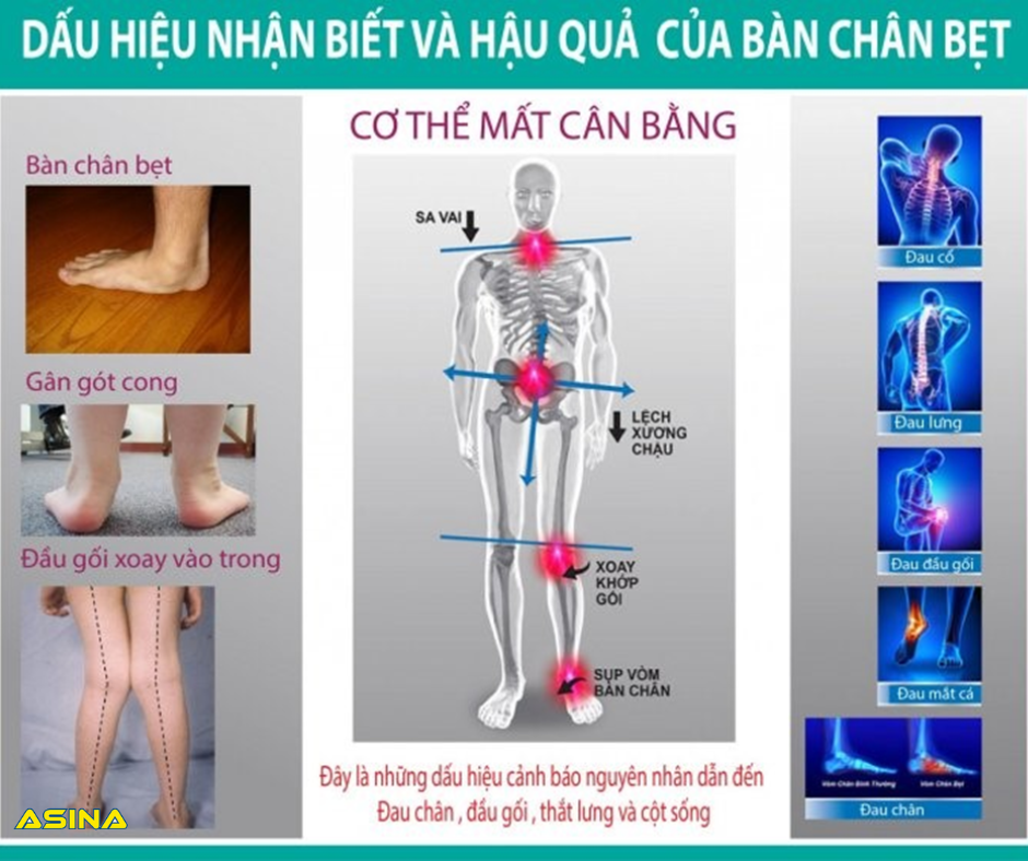 Dấu hiệu nhận biết và hậu quả của bàn chân bẹt