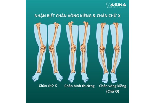 CÁCH NHẬN BIẾT CHÂN VÒNG KIỀNG, CHÂN CHỮ X 