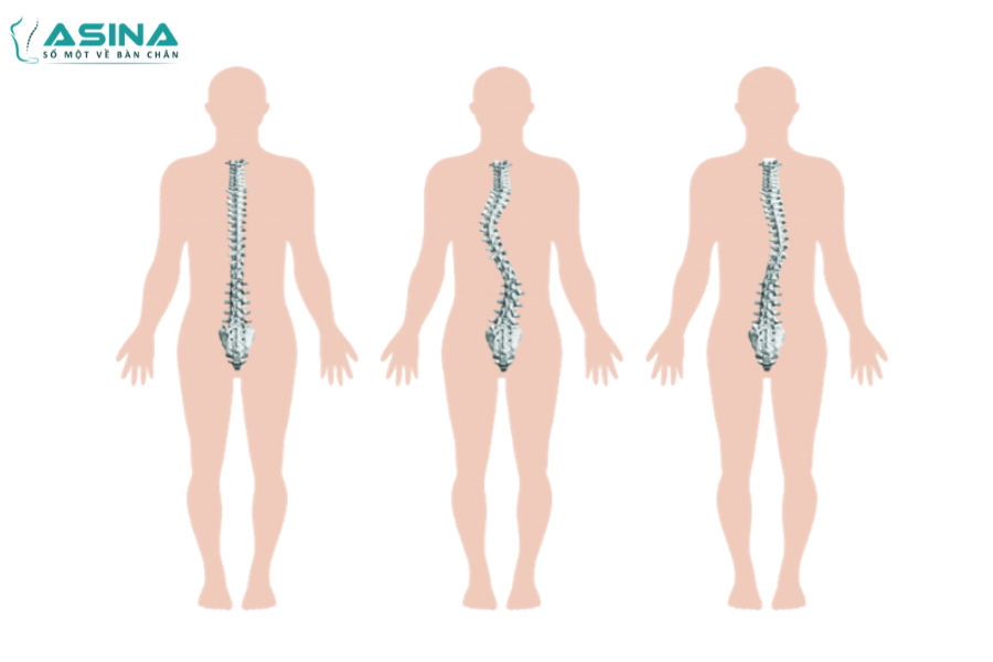 Có nhiều dạng cong vẹo cột sống