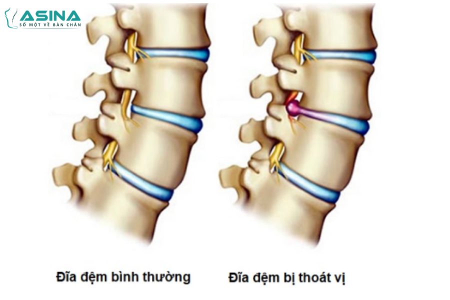 Thoát vị đĩa đệm là gì? 