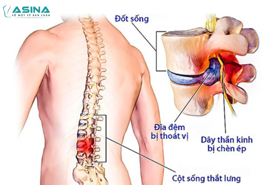 Đau lưng, đau thắt lưng là triệu chứng dễ nhận thấy nhất của bệnh thoát vị đĩa đệm