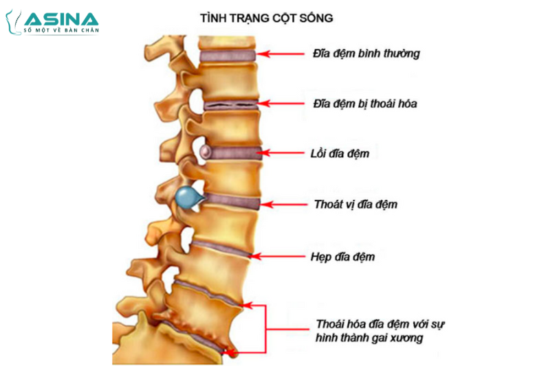 Tình trạng cột sống